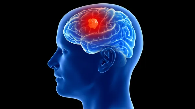 3 People Have Gotten Cancer-Detecting Implants in Their Brains